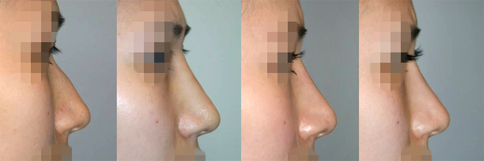 hawk nose surgery korea - Hawk Nose