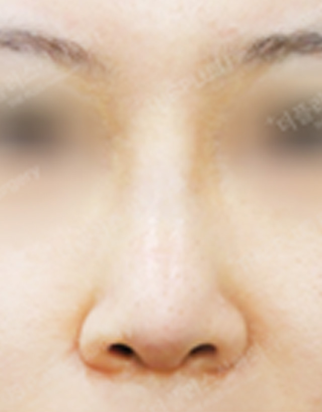 Inflammatory Nose surgery korea - Inflammatory Nose