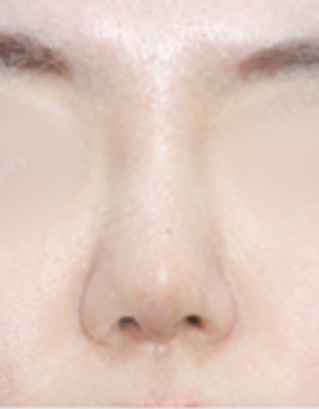 Inflammatory Nose surgery korea - Inflammatory Nose