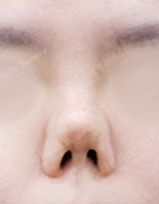 Inflammatory Nose surgery korea - Inflammatory Nose