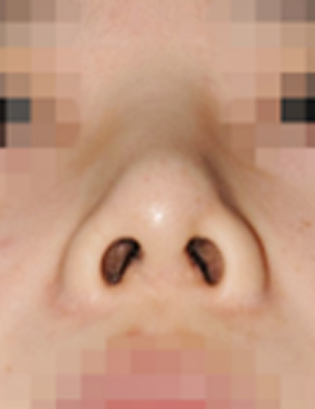 Correction of Failed Rhinoplasty korea - Correction of Failed Rhinoplasty