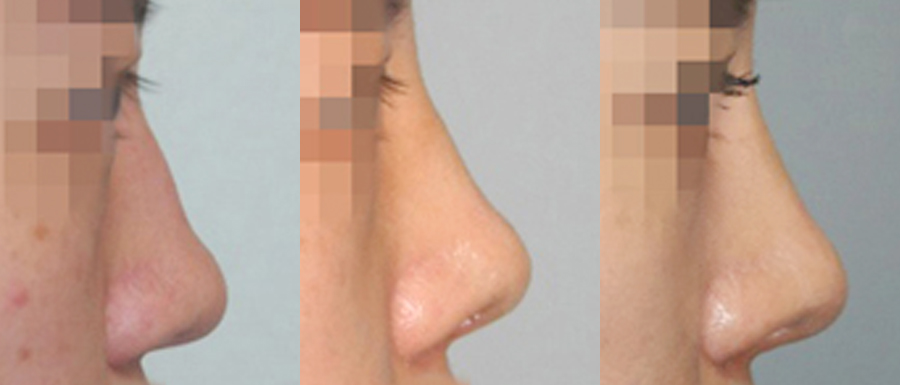 correction of failed rhinoplasty in korea