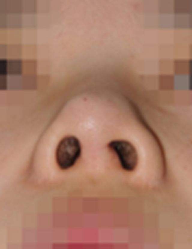 Correction of Failed Rhinoplasty korea - Correction of Failed Rhinoplasty