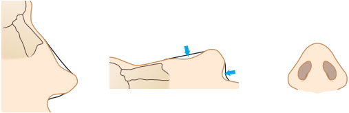 saddle nose reconstructive rhinoplasty in korea