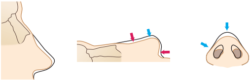 saddle nose reconstructive rhinoplasty in korea