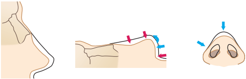 saddle nose reconstructive rhinoplasty in korea
