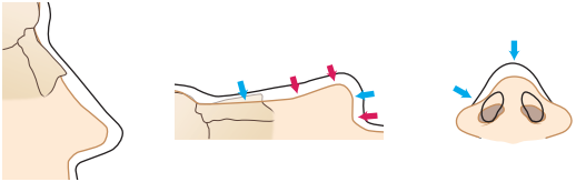 saddle nose reconstructive rhinoplasty in korea
