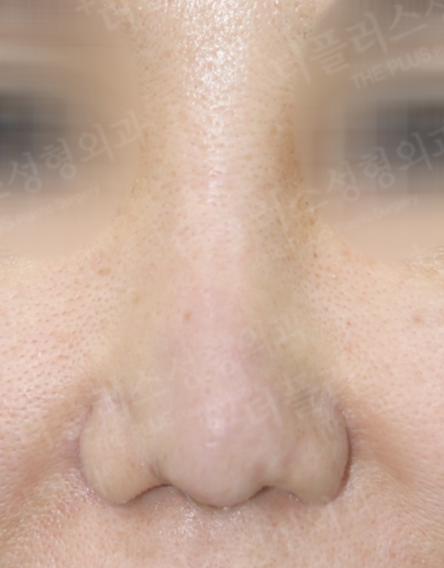 one stage multi-stage reconstructive rhinoplasty in korea
