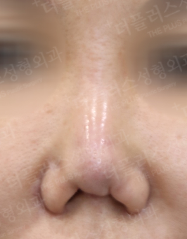 one stage multi-stage reconstructive rhinoplasty in korea