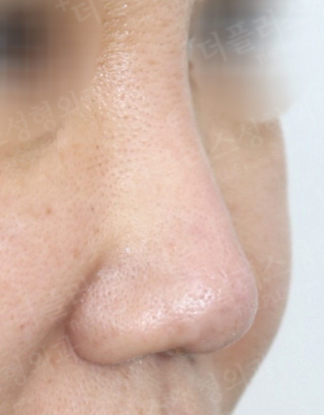 one stage multi-stage reconstructive rhinoplasty in korea
