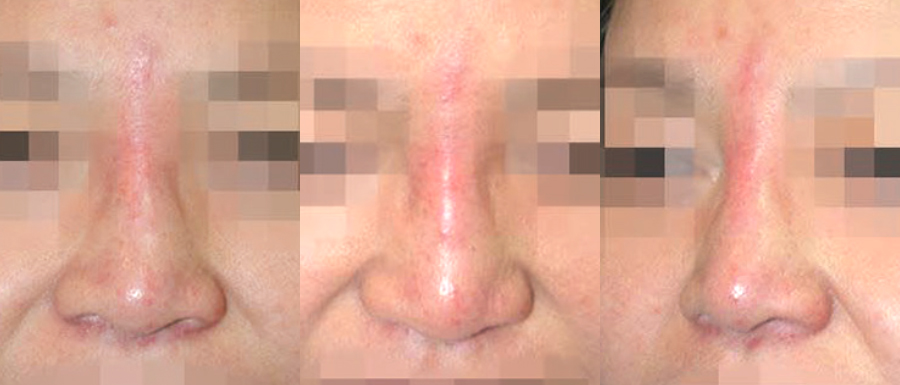 foreign body removal revision rhinoplasty in korea