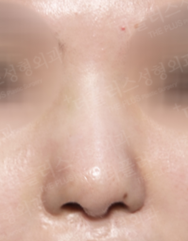 congenital deformity reconstructive rhinoplasty in korea