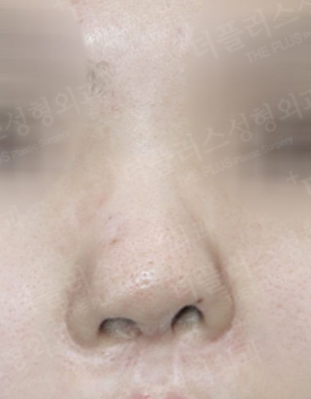 congenital deformity reconstructive rhinoplasty in korea