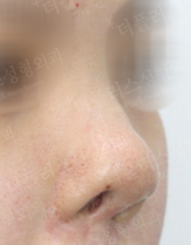 congenital deformity reconstructive rhinoplasty in korea