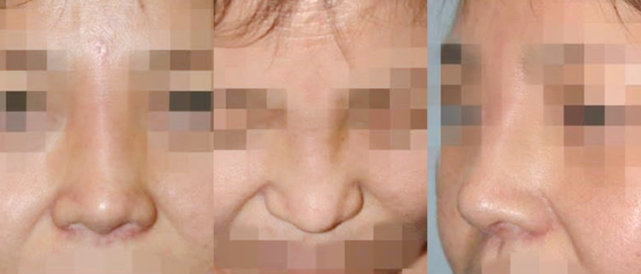foreign body removal revision rhinoplasty in korea