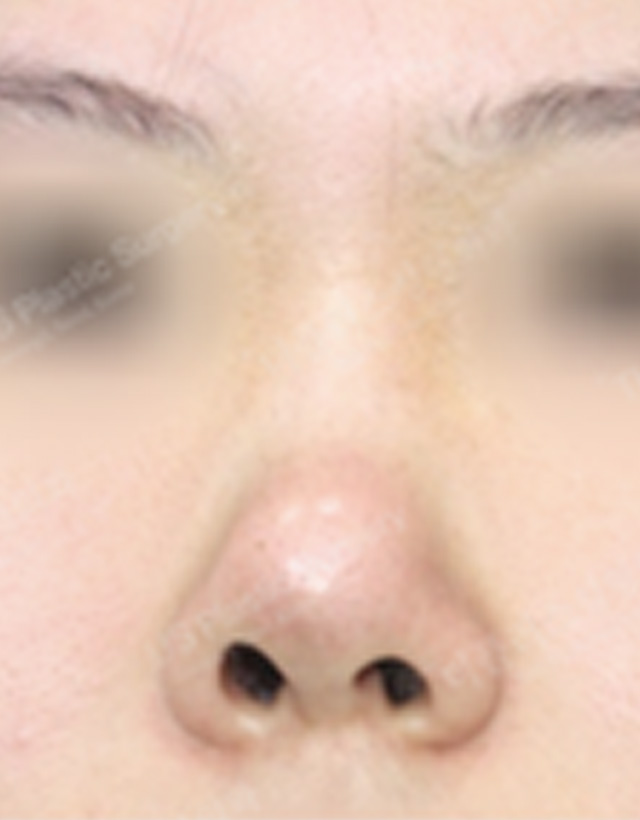 shrunk collapsed nose reconstructive rhinoplasty in korea