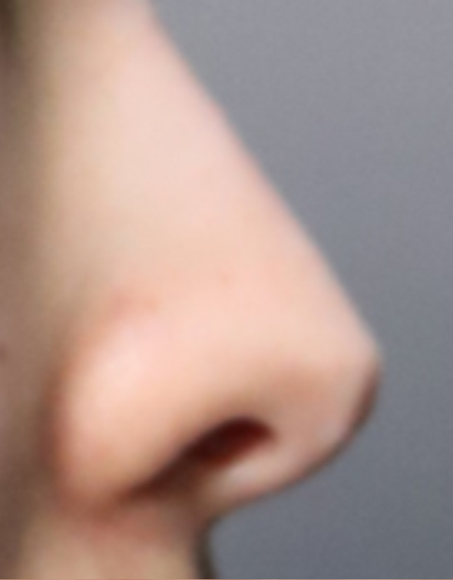 visible nose tip revision rhinoplasty in korea