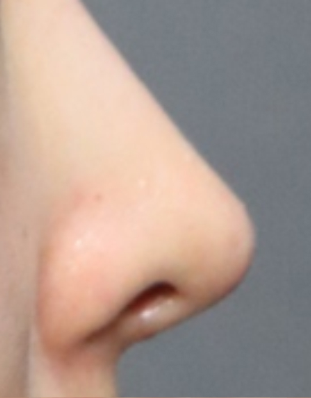 visible nose tip revision rhinoplasty in korea