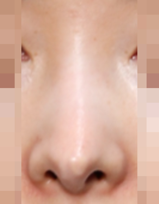 visible nose tip revision rhinoplasty in korea