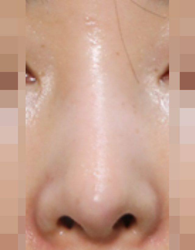 visible nose tip revision rhinoplasty in korea