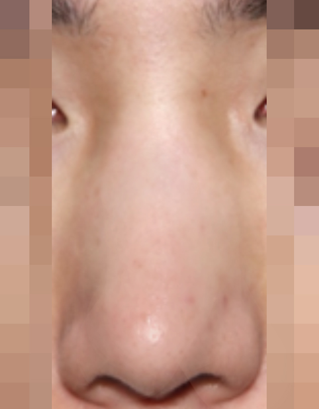 nasal bridge width correction rhinoplasty in korea