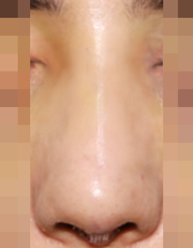 nasal bridge width correction rhinoplasty in korea