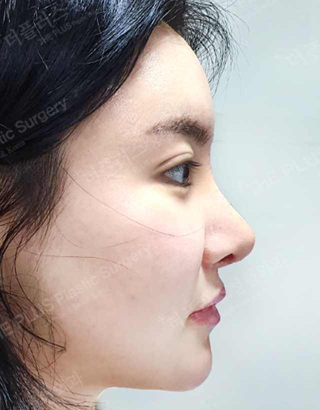 facial contour rhinoplasty in korea