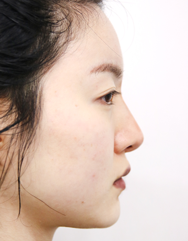 facial contour rhinoplasty in korea