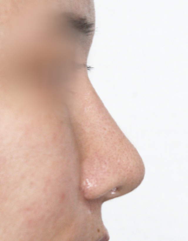 non-implant rhinoplasty in korea
