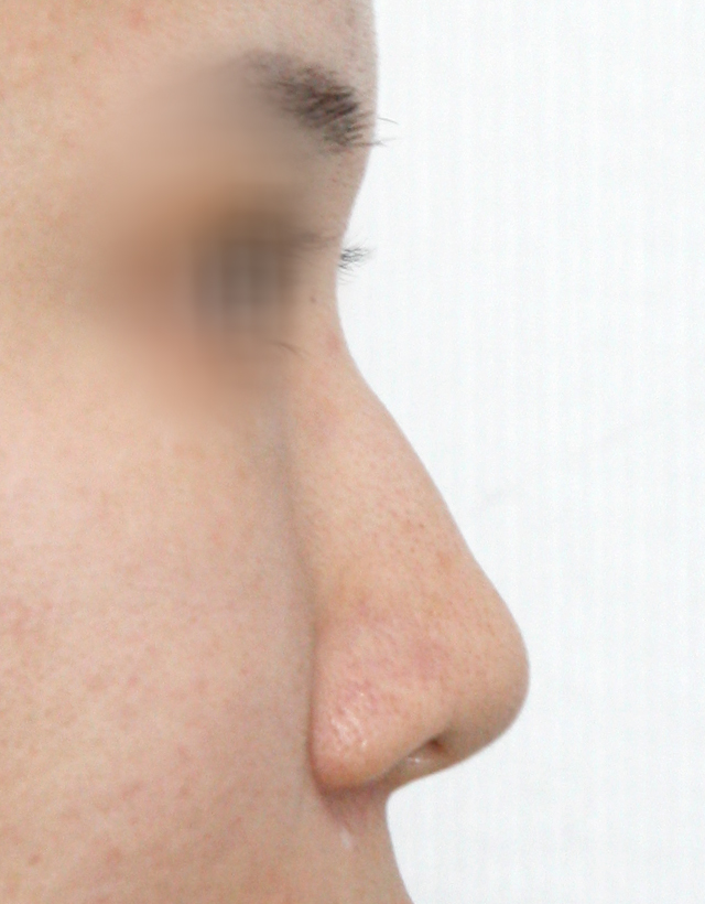 non-implant rhinoplasty in korea