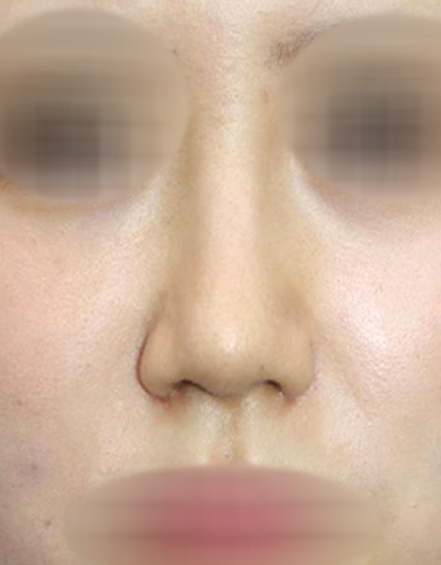 non-implant rhinoplasty in korea