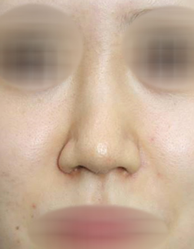 non-implant rhinoplasty in korea