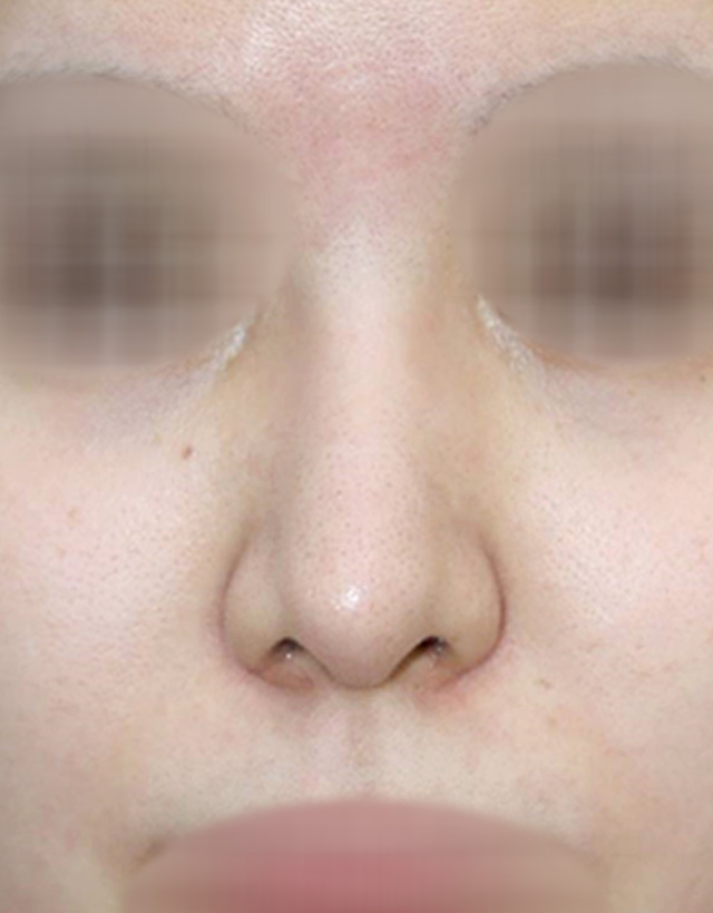 non-implant rhinoplasty in korea