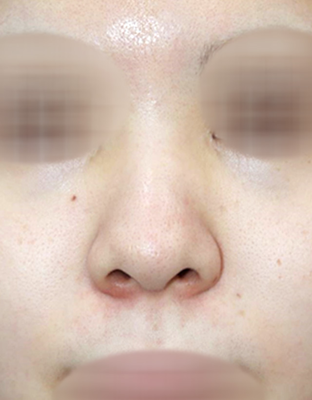 non-implant rhinoplasty in korea