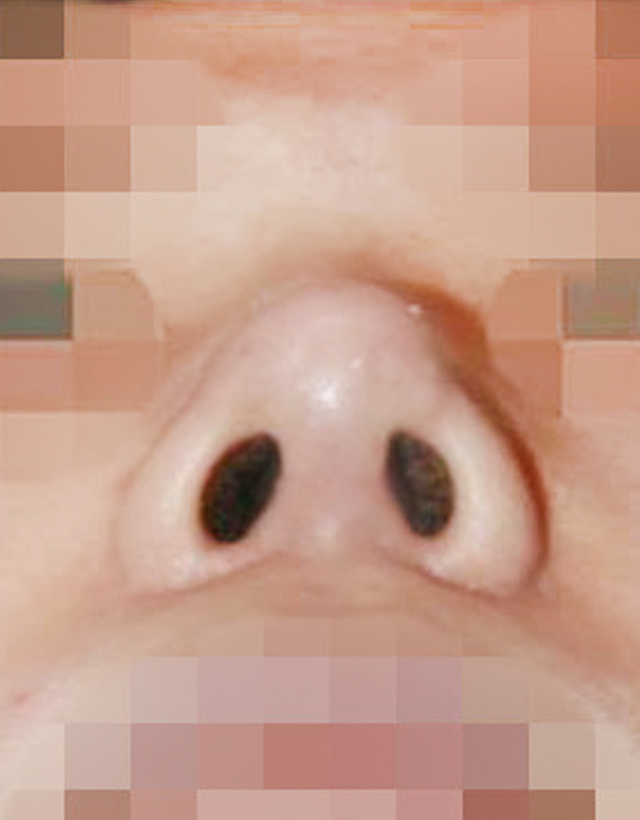 Bulbous nose rhinoplasty in korea