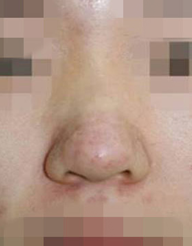 Bulbous nose rhinoplasty in korea