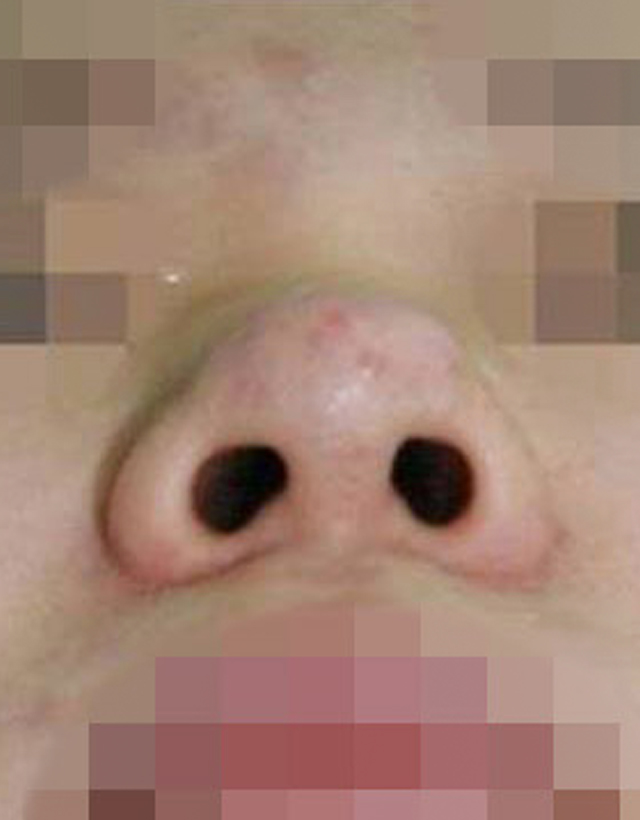 Bulbous nose rhinoplasty in korea