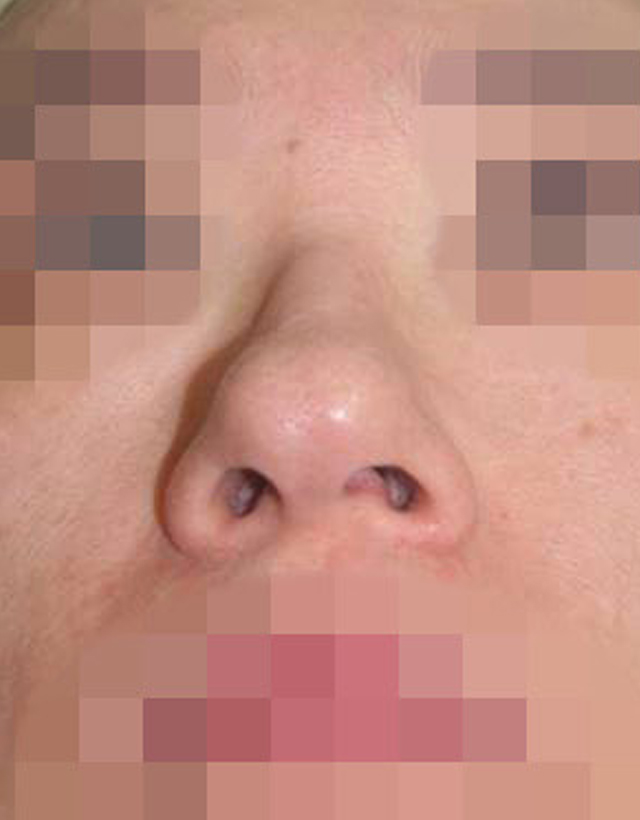 Bulbous nose rhinoplasty in korea