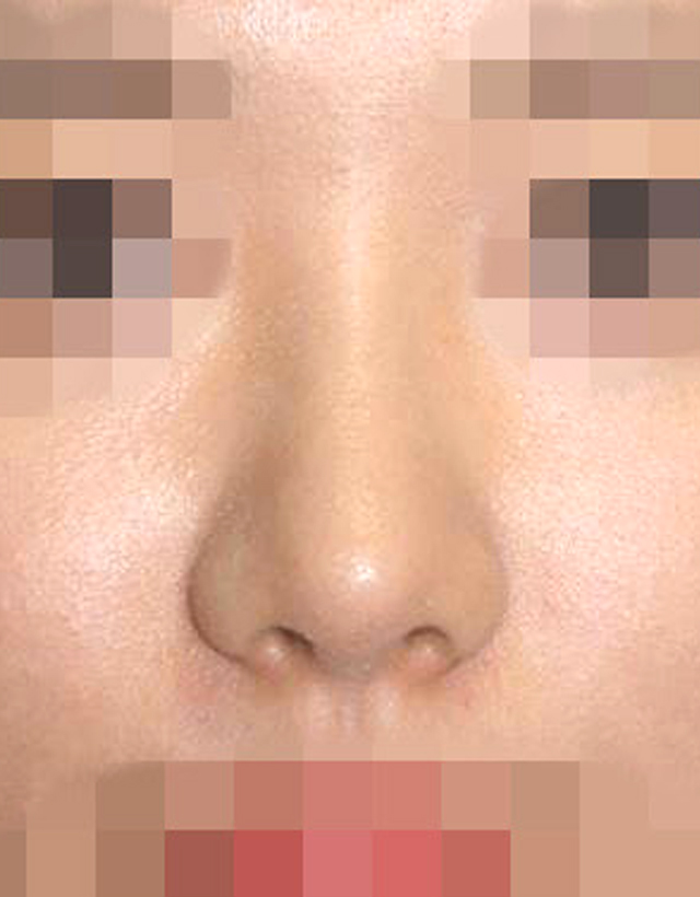 Bulbous nose rhinoplasty in Korea