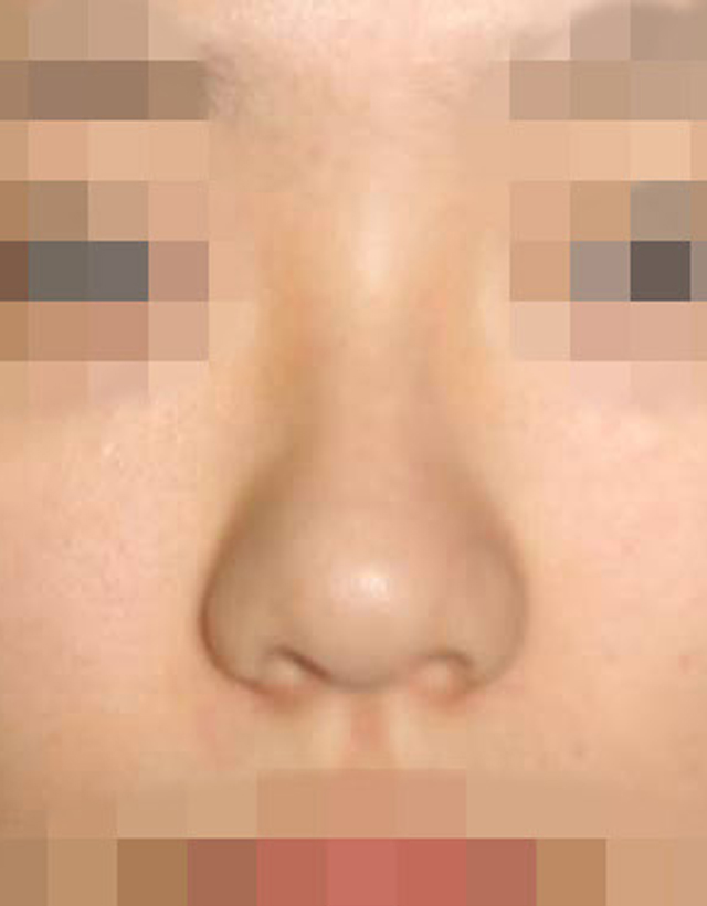 Bulbous nose rhinoplasty in Korea