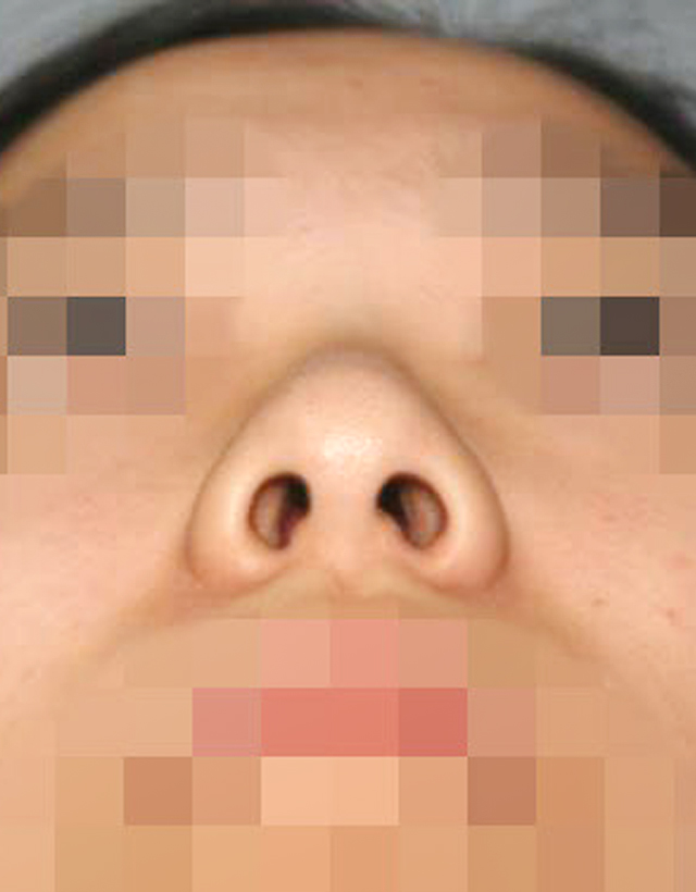 Bulbous nose rhinoplasty in korea