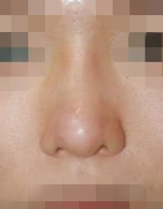 Bulbous nose rhinoplasty in korea