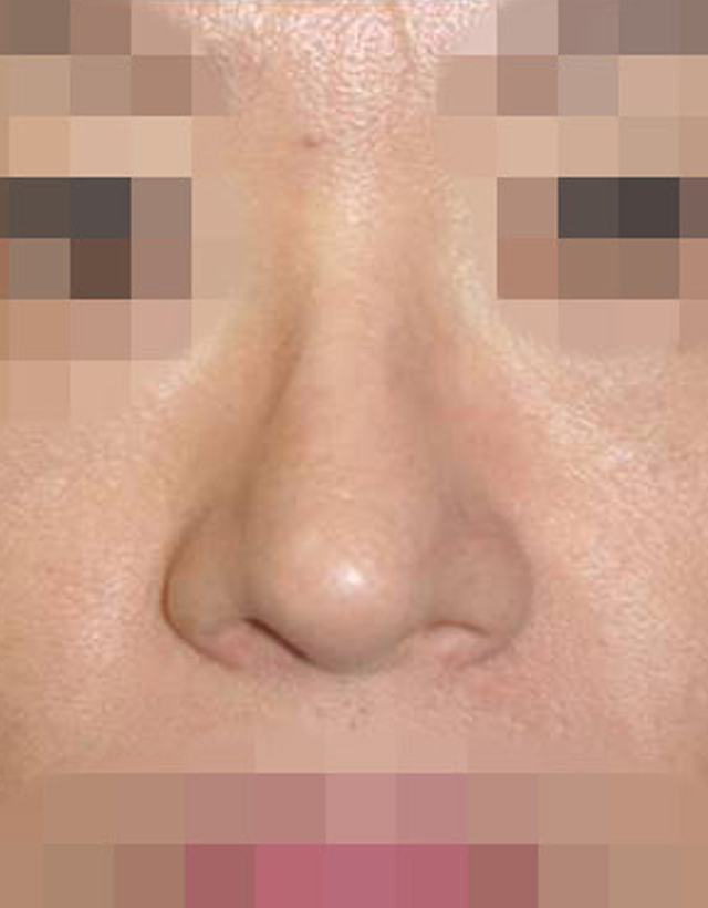 Bulbous nose rhinoplasty in Korea