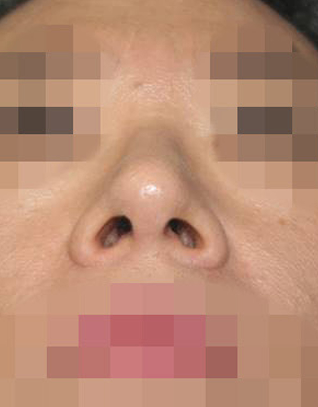 Bulbous nose rhinoplasty in korea