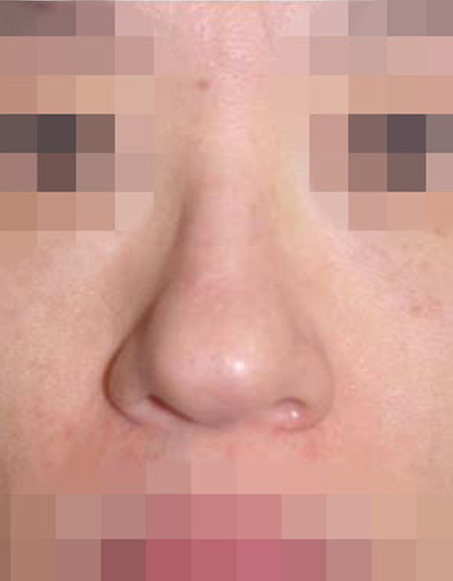 Bulbous nose rhinoplasty in Korea