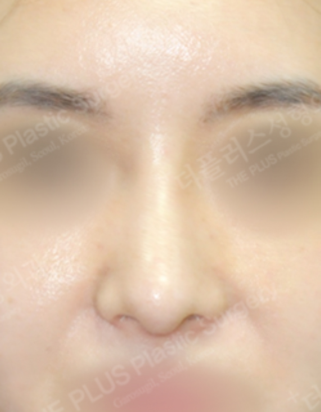 big nose rhinoplasty in korea