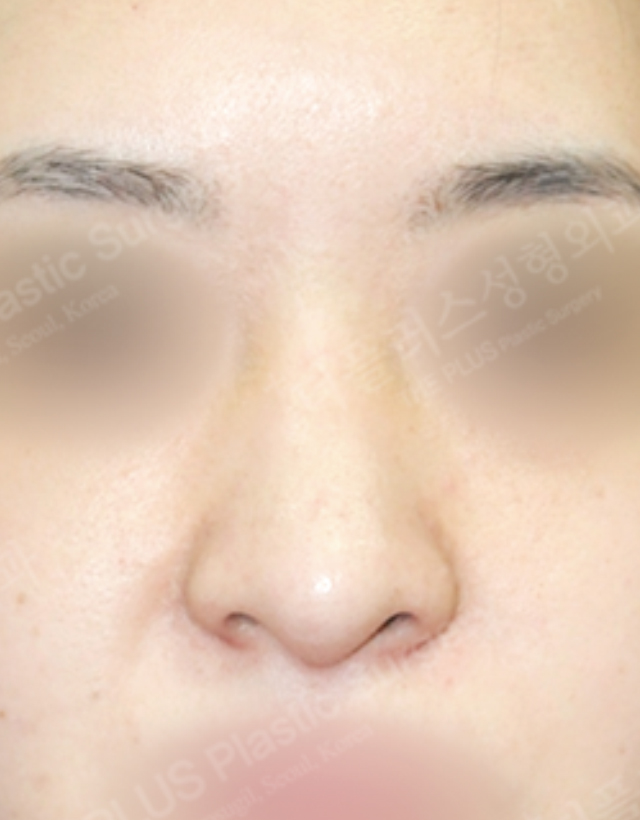 big nose rhinoplasty in korea