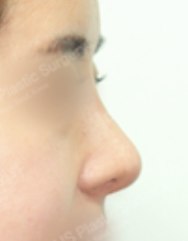 big nose rhinoplasty in korea