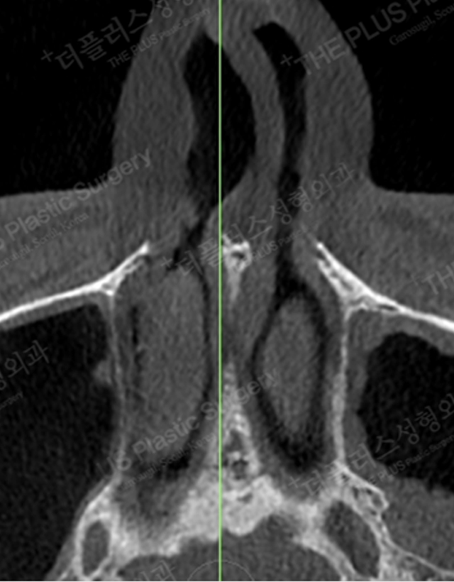 deviated nose septum in korea