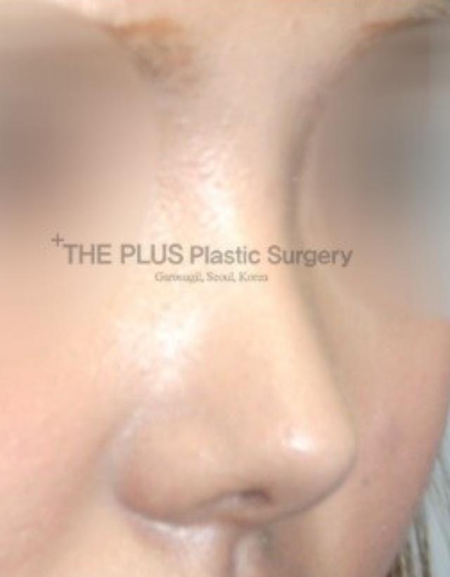 big nose rhinoplasty in korea